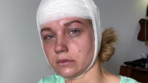 Кристина Асмус испугала снимком с забинтованной головой