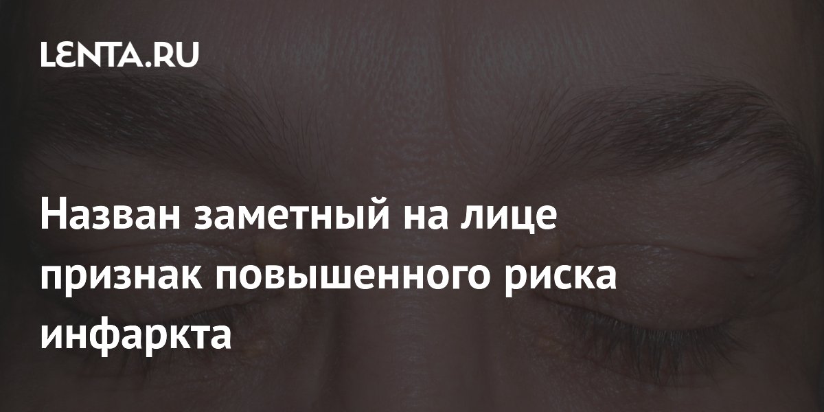 Желтые бляшки на веках назвали маркером риска инфаркта и инсульта